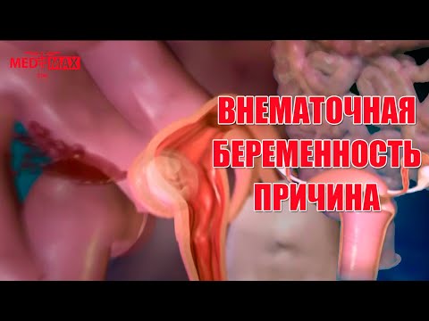 Внематочная беременность. Как происходит? #беременность #внематочнаябеременность #женскоездоровье