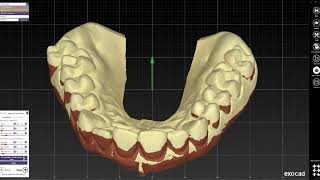 EXOCAD - Gingiva reduction guide design