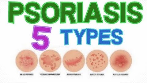 THE 5 MAIN TYPES OF PSORIASIS - PSORIASIS CLASSIFICATION