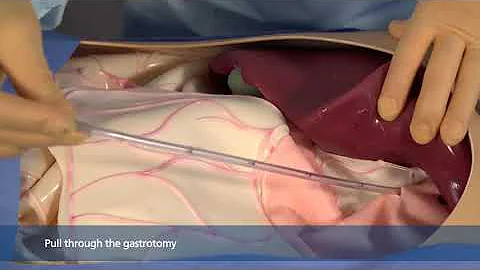 EEA™ OrVil™ Transoral Circular Stapler In Service Video