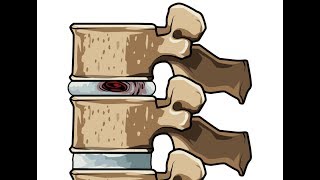 The Degenerative Disc Cascade