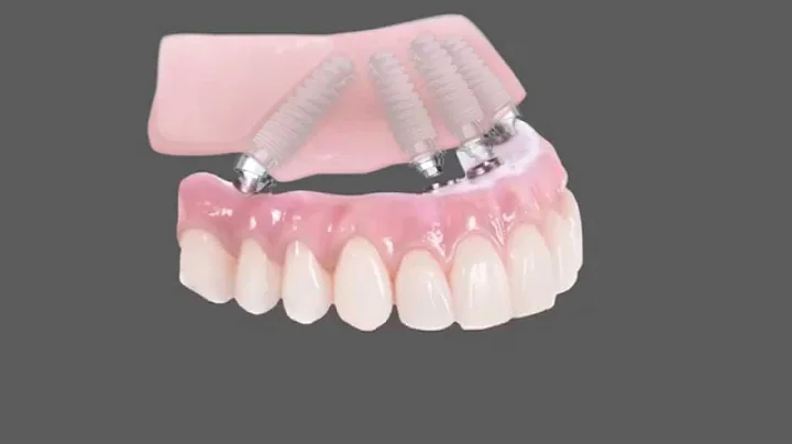 All-On-4 Dental Implants Animation