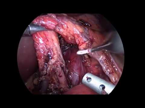 Video: Sindromul Ligamentului Arcuat Median (MALS)