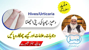 Chapaki (چھپاکی) | Dhappar (دھپڑ) | Hives/Urticaria Causes, Symptoms and Herbal Treatment in Urdu