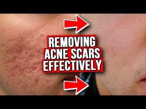 GET RID OF ACNE SCARS (FROM EXPERIENCE)