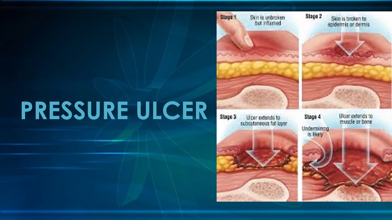 100-useful-notes-for-ireland-aptitude-test-preparation-pressure-ulcer-youtube