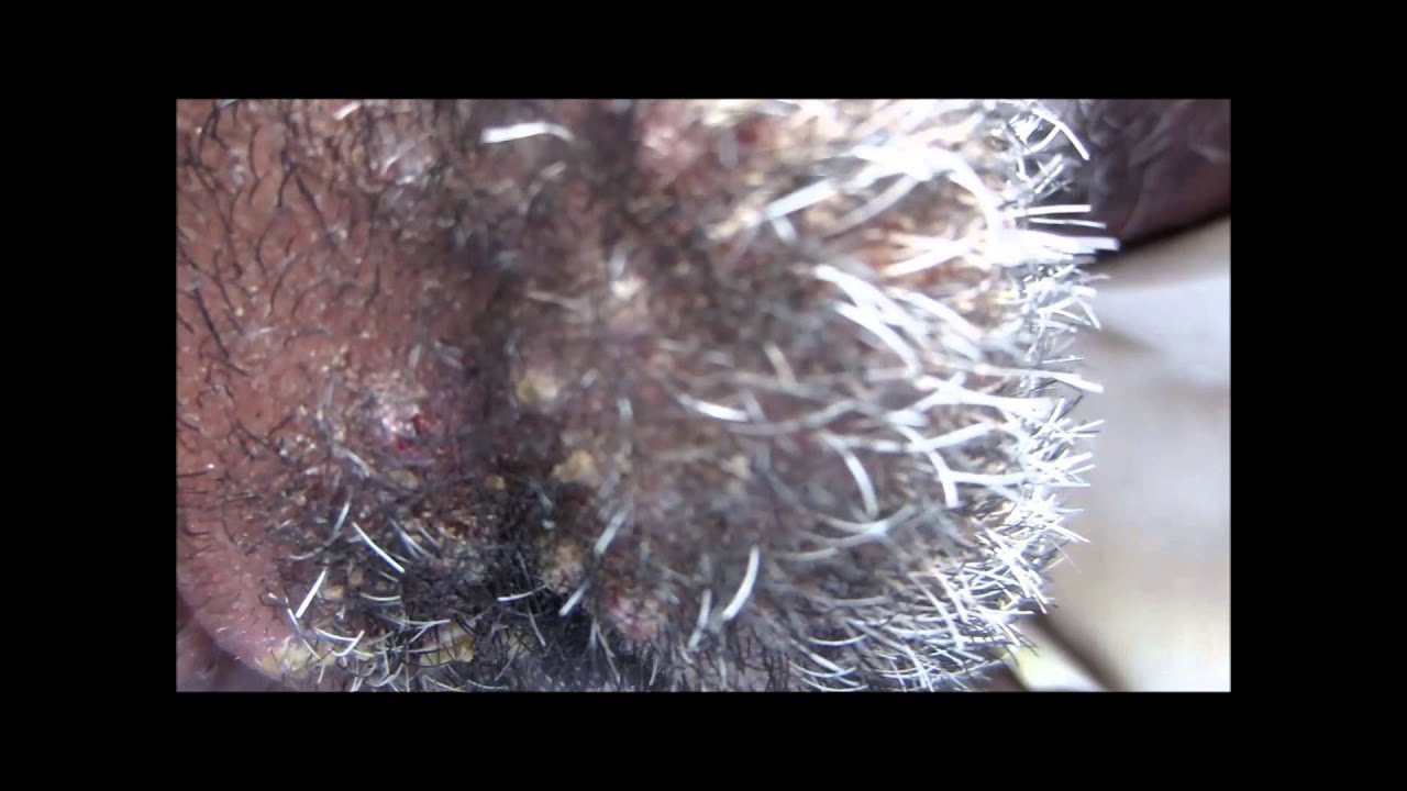 Severe Folliculitis Of Beard - YouTube