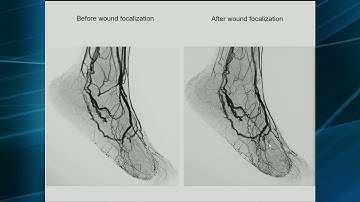 The Limflow Venous Arterialization System Via Percutaneous Punctures