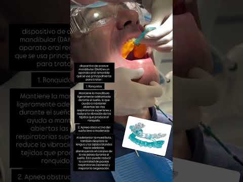 Dispositivo de avance mandibular para manejo de apnea del sueño 😴