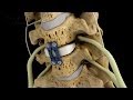 C4-5 Anterior Cervical Diskectomy with Fusion
