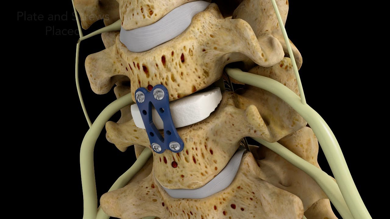 Enyhítse a fájdalmat a mellkasi gerincben osteoarthritis osteoporosis kezelése