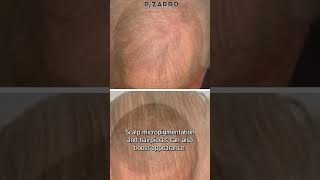 Can You Regrow Male Pattern Baldness?