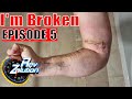 I&#39;M BROKEN - Physiotherapy - Episode 5