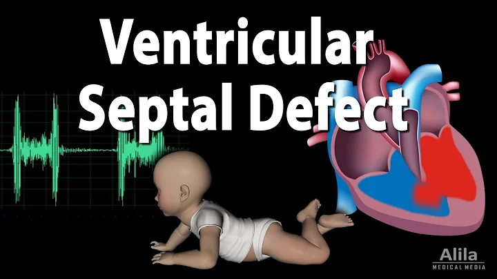 Ventricular Septal Defect, Animation - DayDayNews