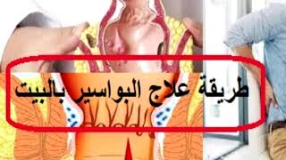 طريقة علاج البواسير والحكة بالبيت .. علاج البواسير بالاعشاب نهائيا