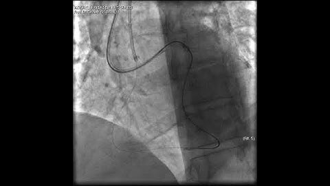 Aortic dissection and radial rupture during retrograde CTO PCI: Management of complications VİDEO 22