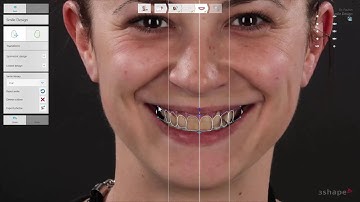 Thiết kế Nụ Cười - 3Shape Smile Design