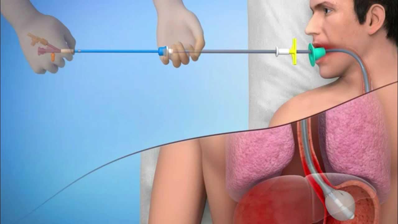 Процедура зонд. Нитиноловый стент для пищевода. Гастроэнтеролог трубка.