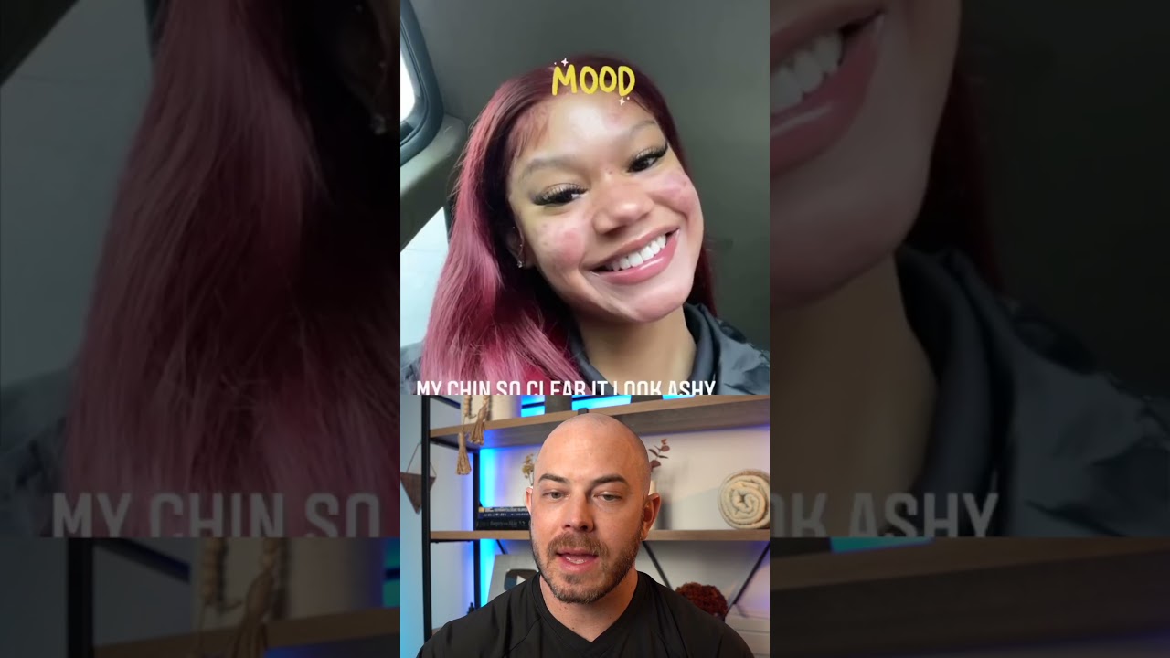 Doctor reacts to outstanding acne transformation on accutane! 