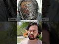Garmiyon Mein Hair Fall Kaise Rokein?