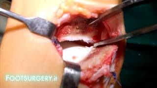 Legamenti Caviglia e Osteocondrite 1 parte(Il filmato mostra l'operazione che si fa sulla caviglia per curare l'osteocondrite dell'astragalo. Per saperne di più visita: ..., 2012-02-06T19:56:37.000Z)