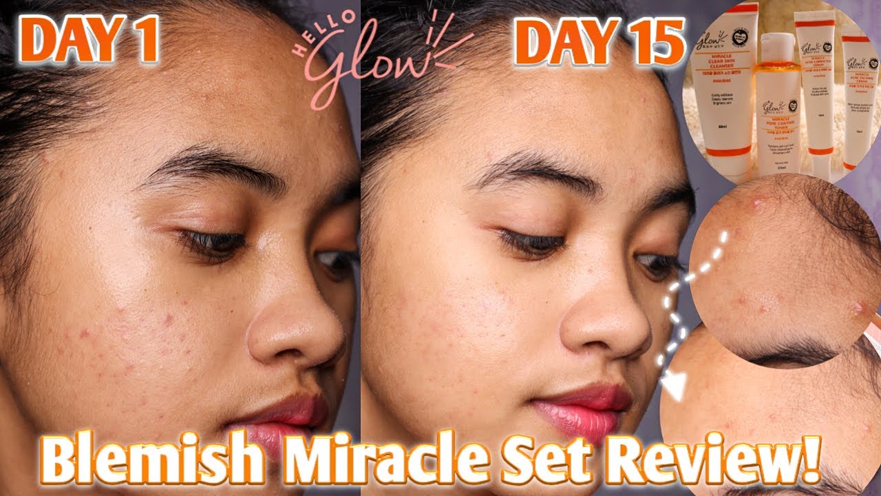 MILD NA REJUV? NO VISIBLE PEELING! HELLO GLOW BLEMISH MIRACLE SET REVIEW! Camille Velasco