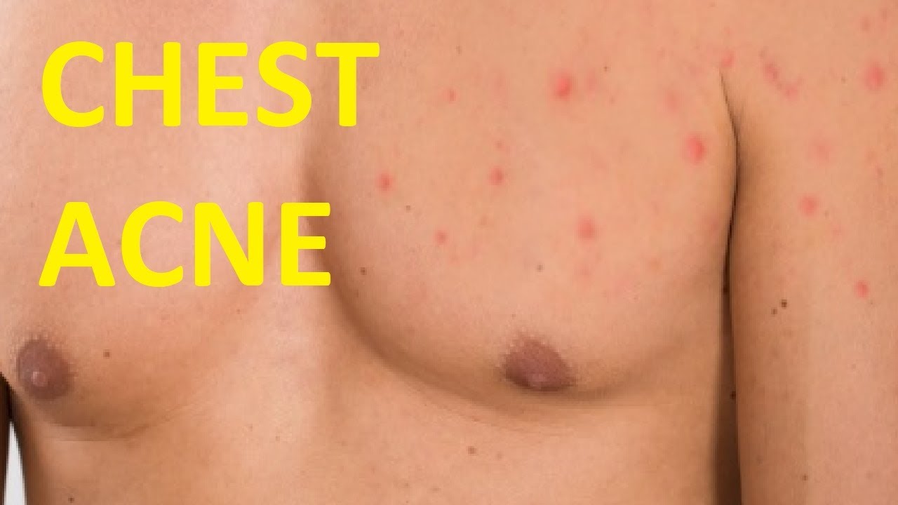 Acne: The Easy Way