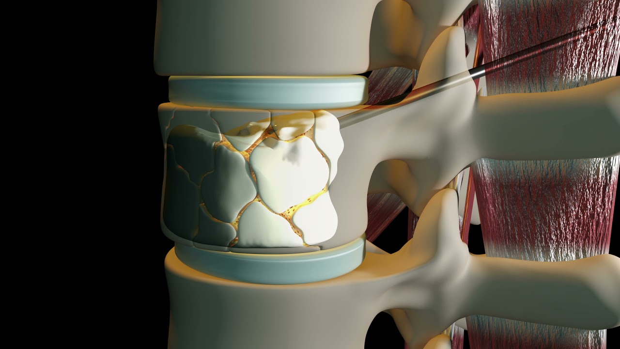Injection Of Bone Cement For Fractured Vertebrae YouTube
