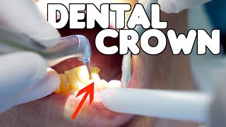Dental Crown Procedure EXPLAINED Resimi