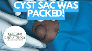 This Cyst Sac Had SOOOO Much Inside! | CONTOUR DERMATOLOGY