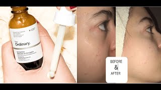 Tổng hợp 25 the ordinary granactive retinoid 2 emulsion review bạn nên biết