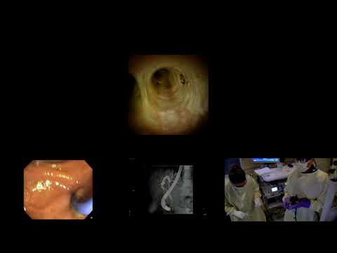 Endoscopic treatment of a refractory benign biliary stricture