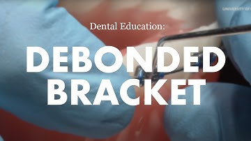 Orthodontic Emergencies: How to remove a debonded bracket from a fixed orthodontic appliance (brace)