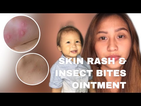 Video: Paano Makakatulong Sa Isang Bata Pagkatapos Ng Kagat Ng Insekto