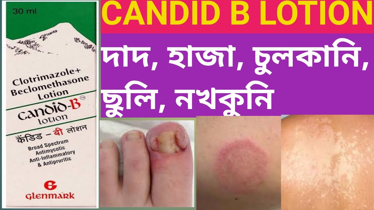 Candid B Lotion review कैंडिड बी लोशन Broad Spectrum Anti Itching Lotion -  YouTube