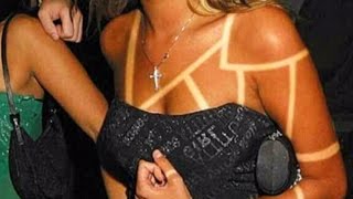 'Sunburn art': Disturbing trend causing skin damage