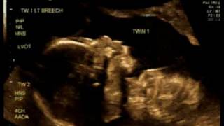 20_Weeks_3a.avi