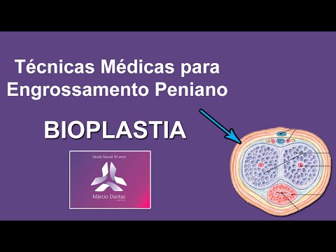 Engrossamento Peniano (Bioplastia Peniana)