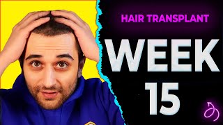 Hair Transplant 15 weeks RESULTS!!! | Istanbul Turkey | 2022