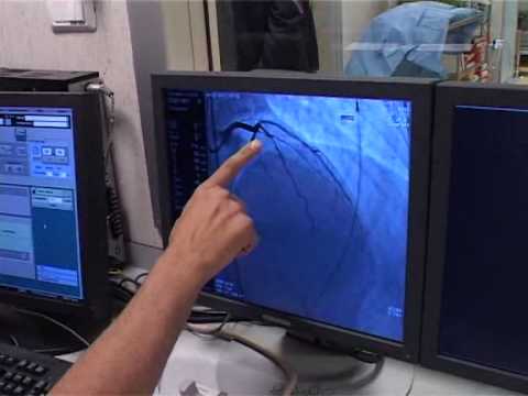 LA DIAGNOSTICA PER IMMAGINI PER IL CUORE E PREVENZIONE INFARTO - YouTube