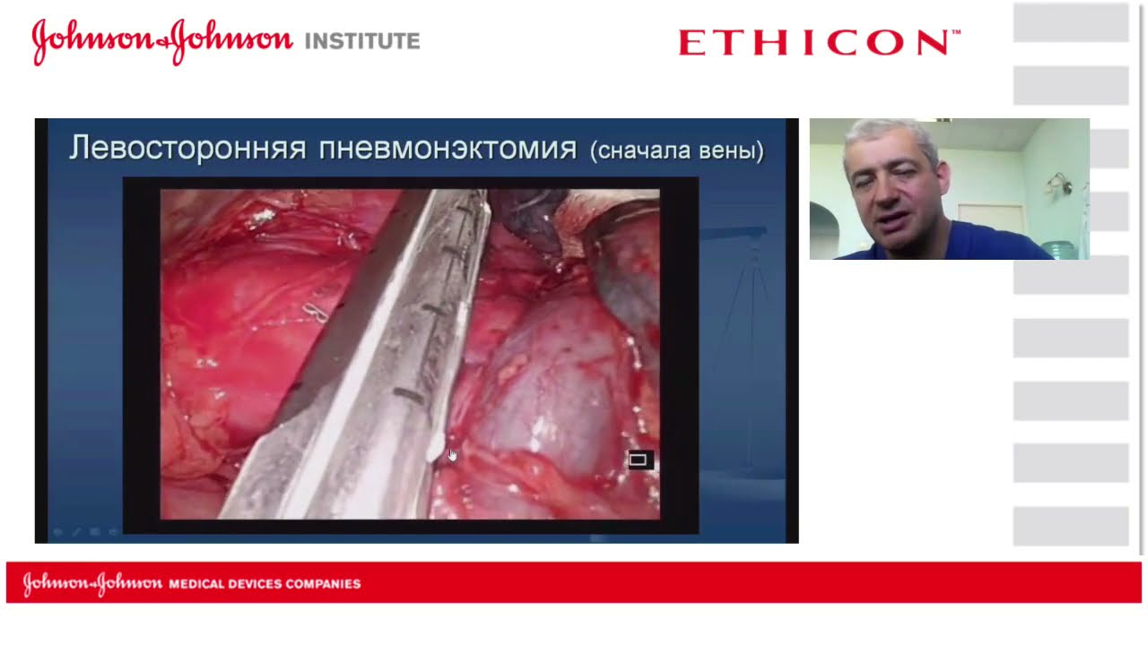 Особенности техники торакоскопической пневмонэктомии