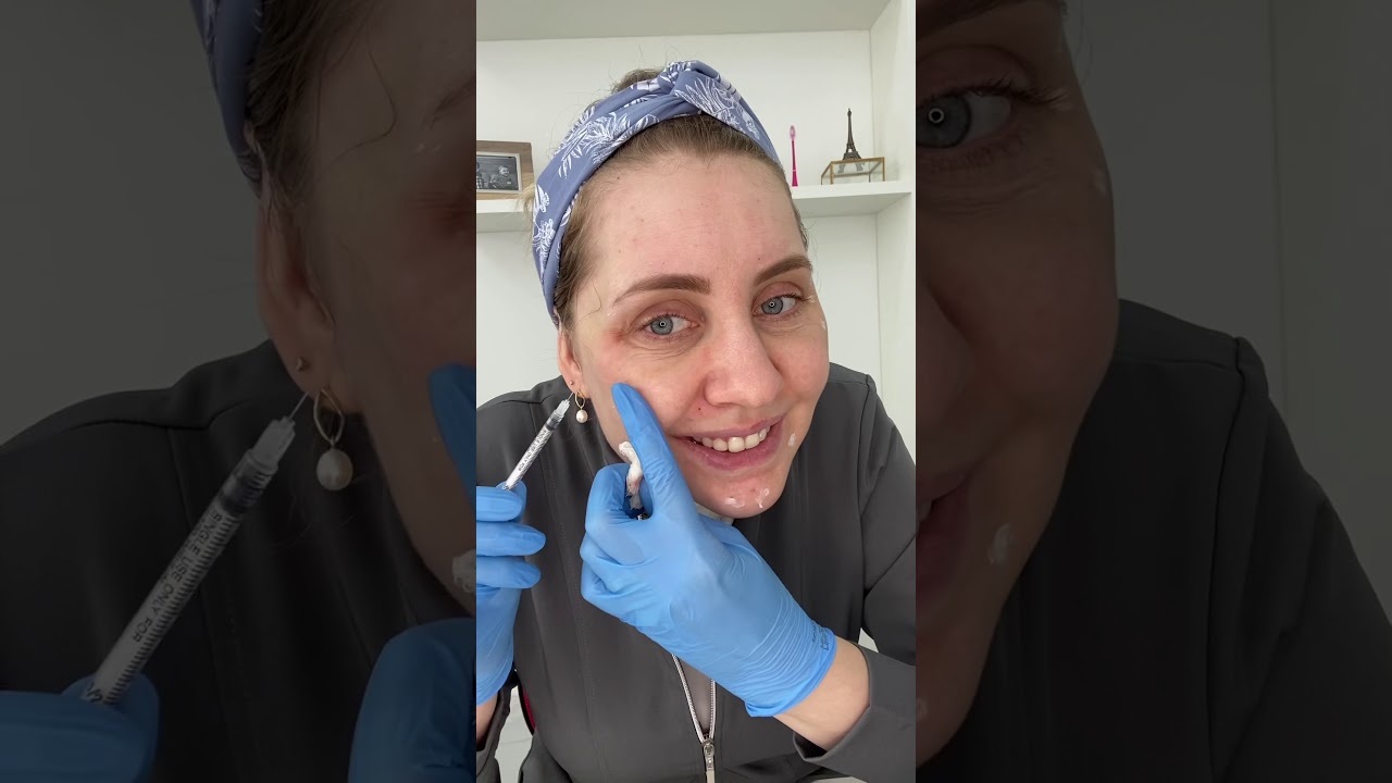 Minha aplicação de Toxina - Dra Camila Scremin