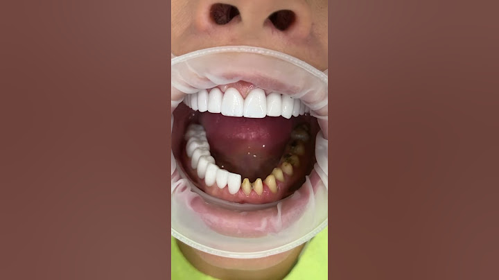 Da li i vi želite ovakav osmeh? #dentist