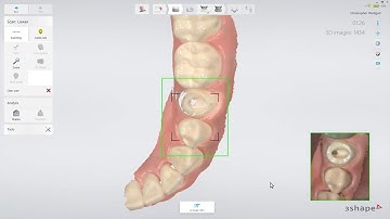 3Shape TRIOS   Post and core workflow