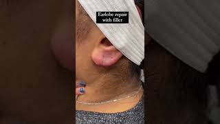 Earlobe Repair With Filler