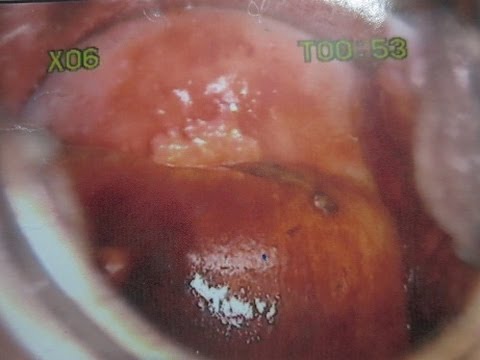 Digital Mucous Cyst (Ganglion on the Finger): Pictures ...