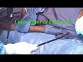 Steps of diagnostic upper gi endoscopy  dr s easwaramoorthy