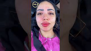 سحر #الفيلر  ونتيجة حقن الشفاة بعد الجلسة مباشرةً |The Magic of #filler  and the results #fyp #viral