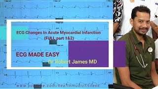 ECG  in Acute MI (FULL Part 1 & 2) ECG VLOG #9