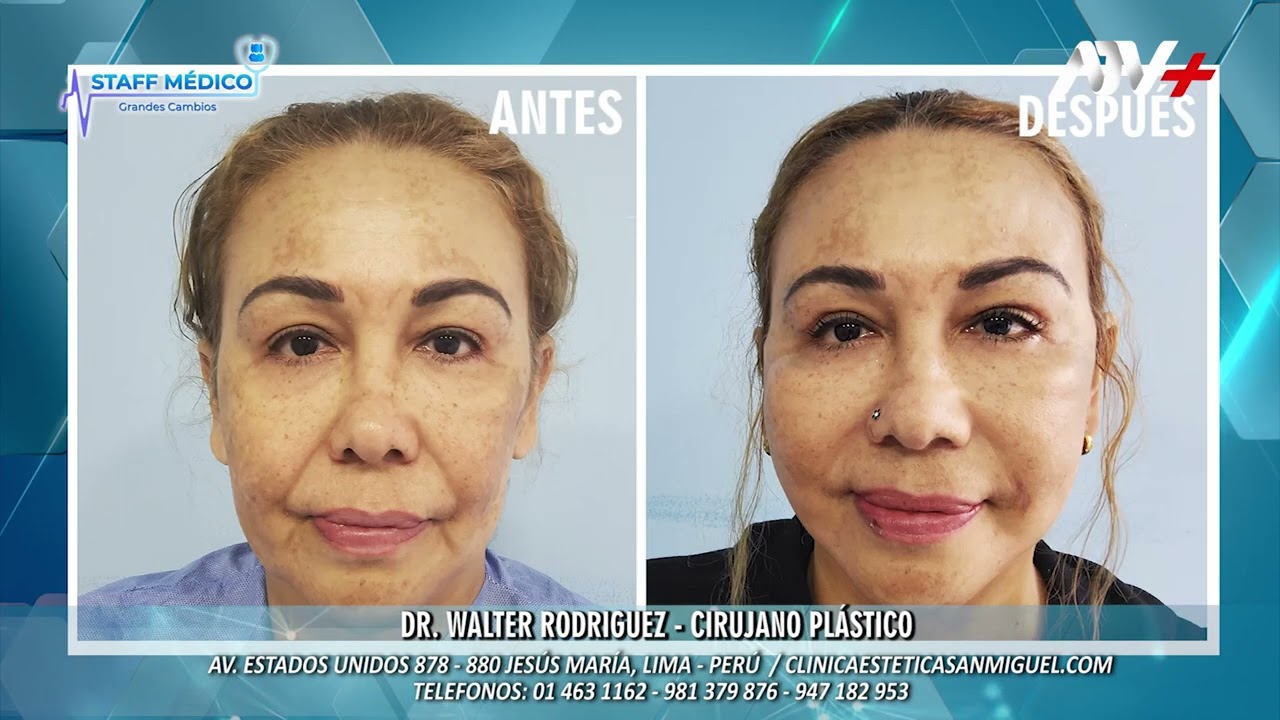 Lifting facial sin cirugía en Monterrey, Hospital San José